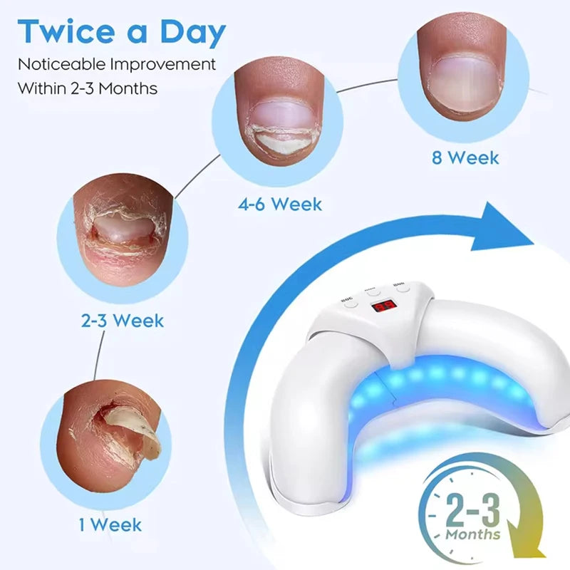 Fungal Nail Laser Device For Toenail Fungus Treatment