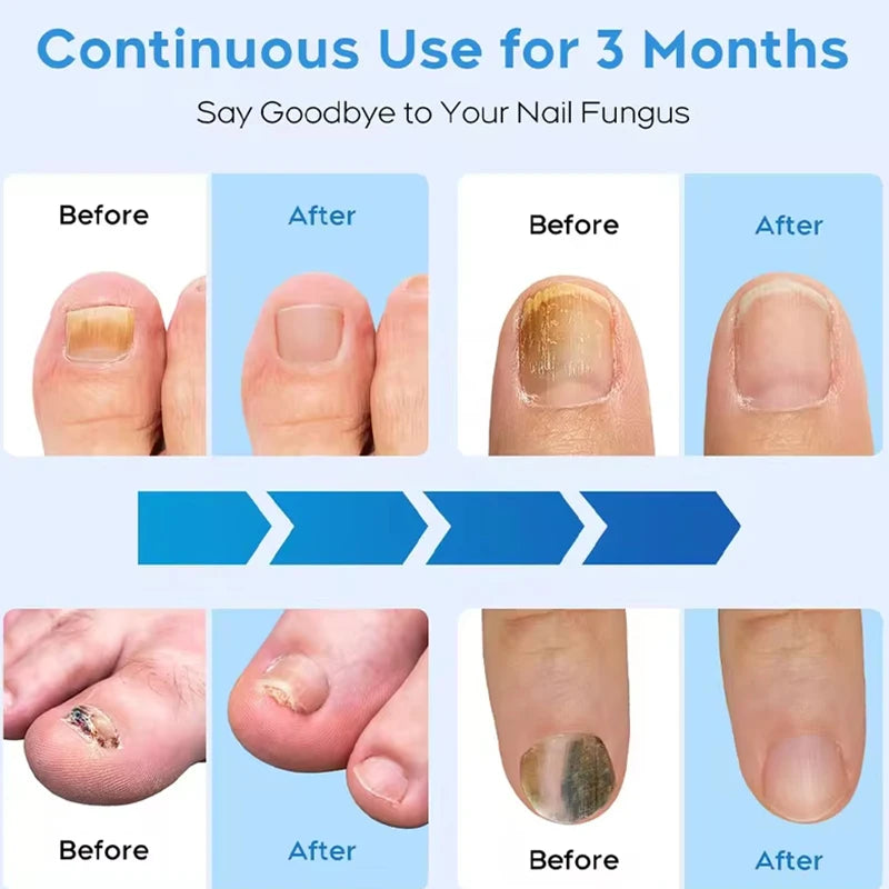 Fungal Nail Laser Device For Toenail Fungus Treatment
